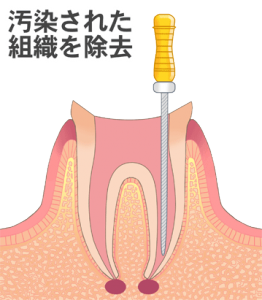 根管治療