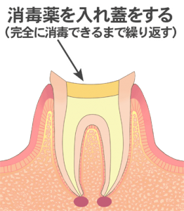 根管治療