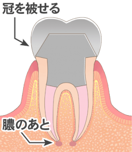 根管治療